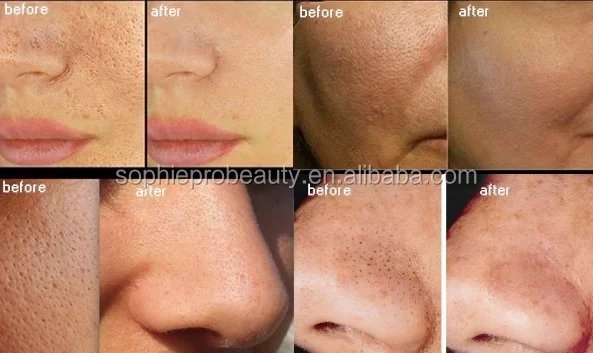 portable 6 in1 frozen skin h2o2 aqua skin peel oxygen facial machine portable