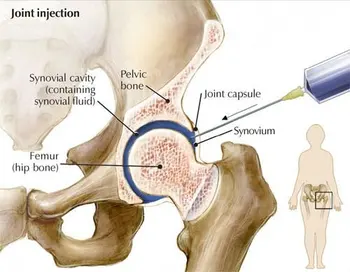 Side effects of steroid injections for osteoarthritis