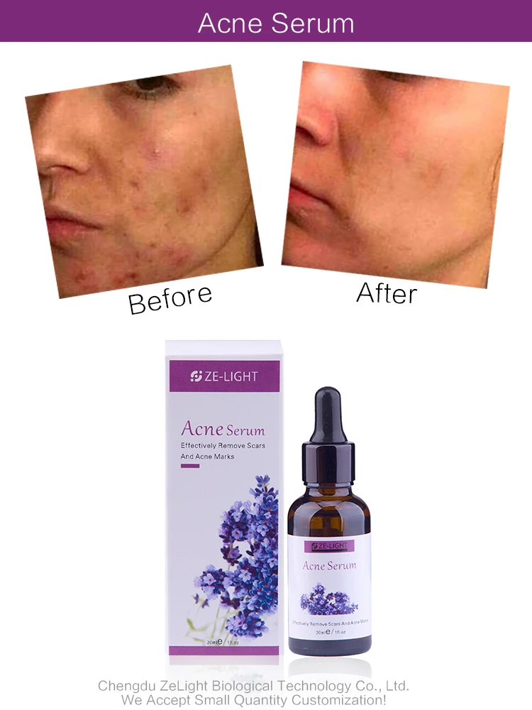 ze light acne serum