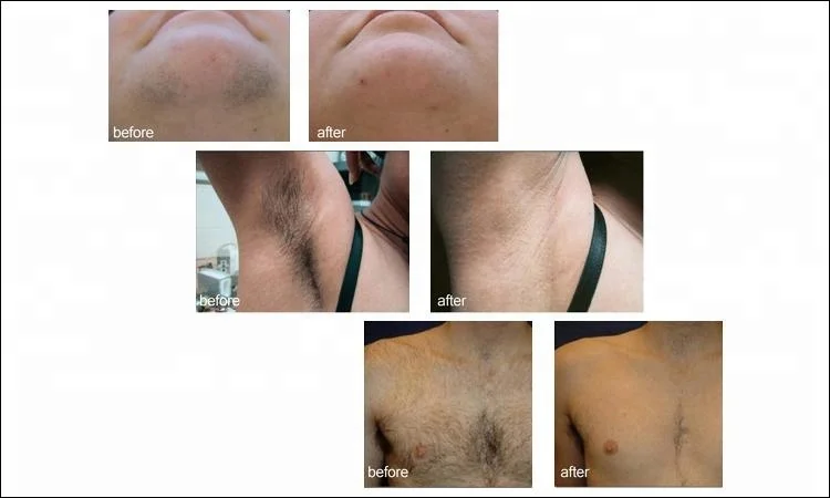 808nm 的半导体激光脱毛机