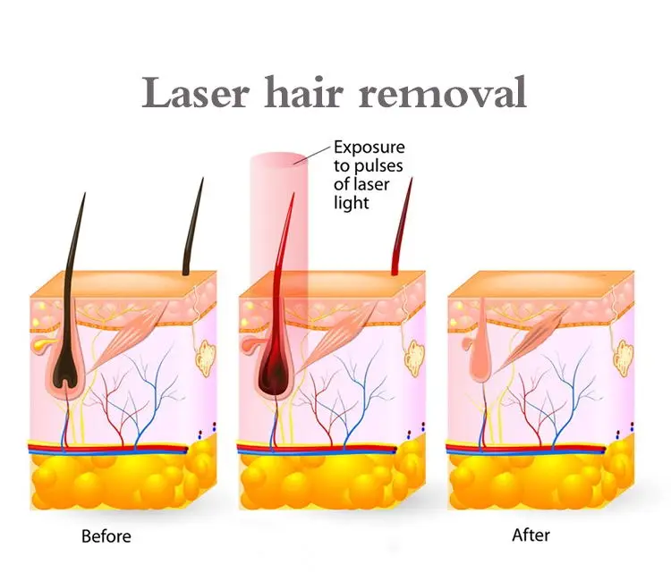 China best selling Diode laser 808 hair removal machine price/808nm diode laser machine