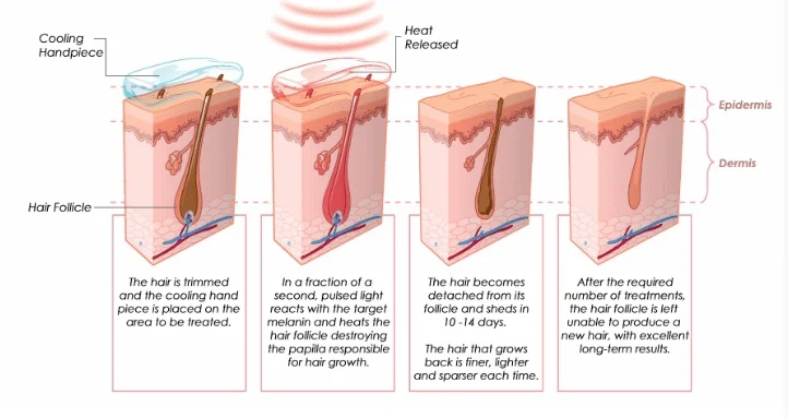 2019 Good Quality Hair Removal Opt Ipl Laser Machine