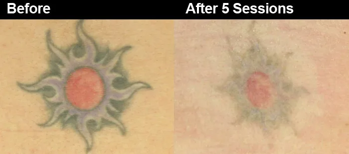 100+ [ Laser Tattoo Removal Pricing U0026 ] | China Q ...