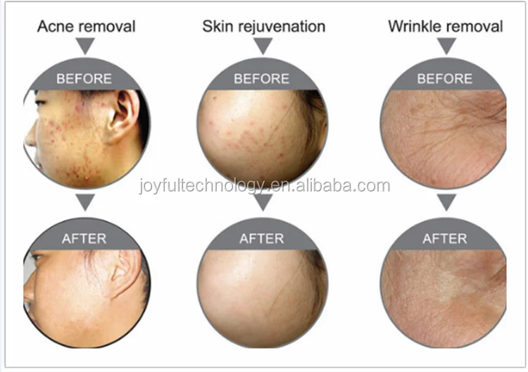 led light rejuvenation