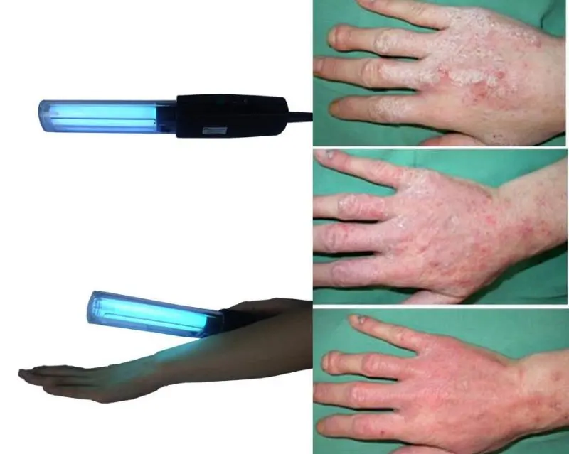 Derma Light Therapy For Psoriasis,Vitiligo,Eczema,Atopic Dermatitis,Skin Disease Buy Uvb Lamp