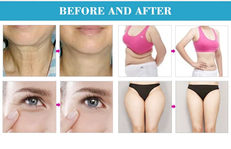 velashape v9 (6).jpg