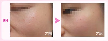 hair removal cream ipl device multifunction.png