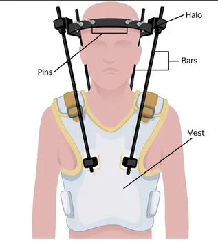 Potrebuji Rafinerie Prehistoricky Halo Vest Cervical Tom Audreath Poradce Papirnictvi