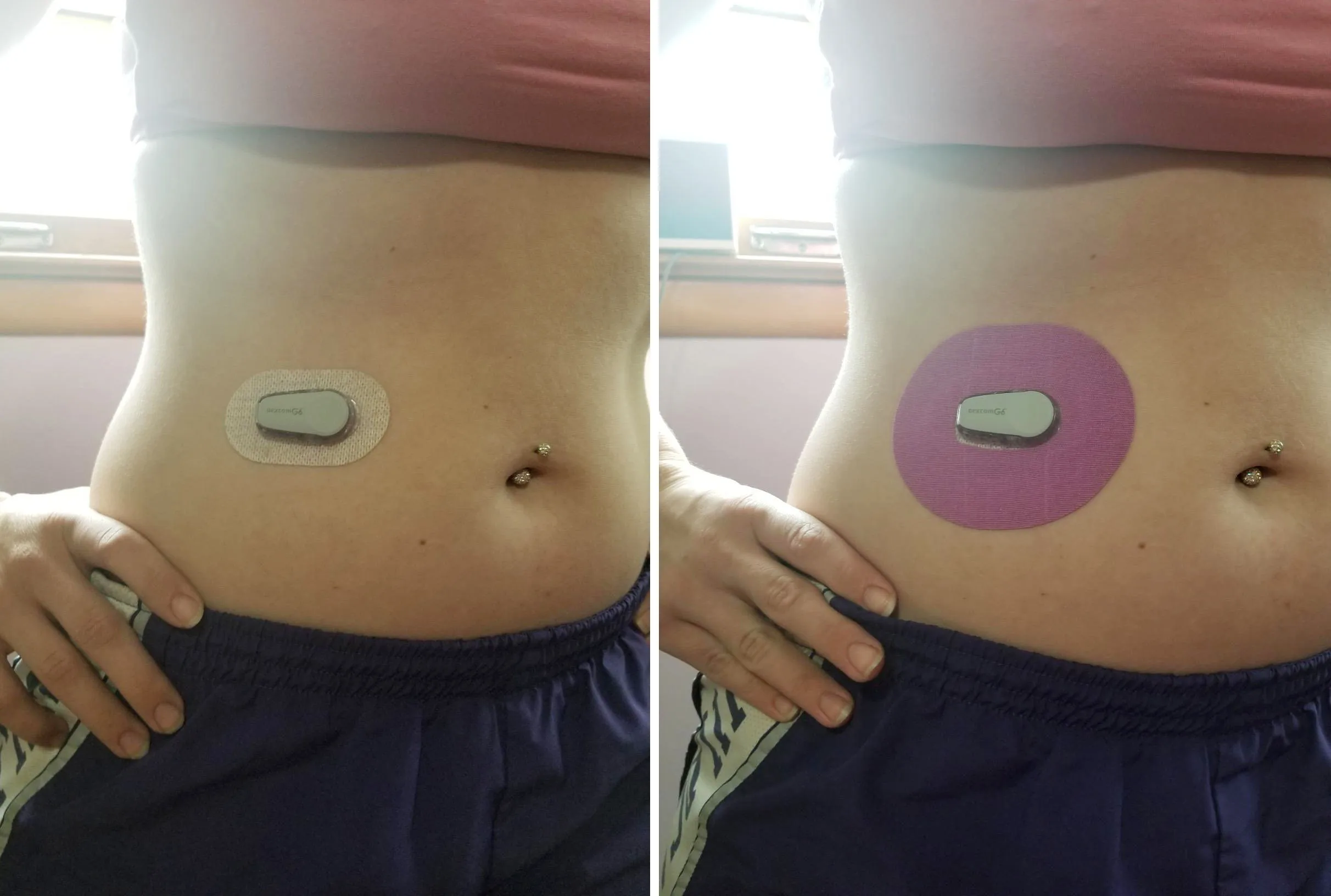 G6 Patch Cgm Blood Glucose Sensor Diabetic Adhesivepatchskin