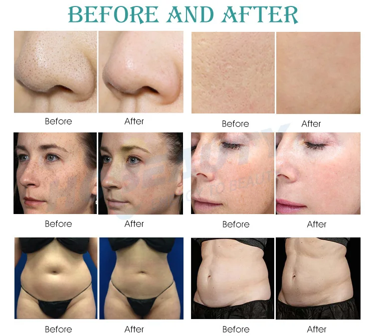 Beauty equipment dermabrasion anti wrinkle 7 in 1 alice super bubble peel oxygen for face rejuvenation