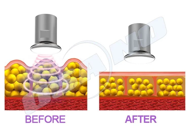 shockwave therapy for penis