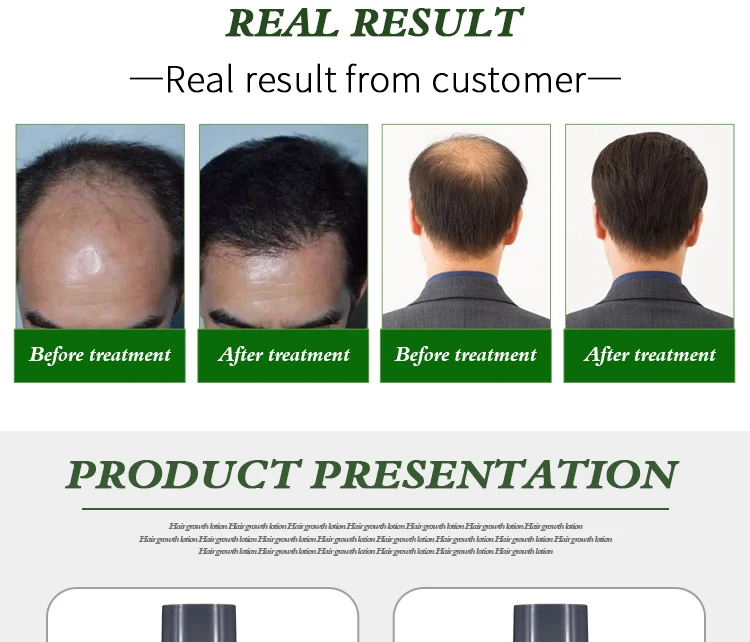 Hair Regrowth Oil For Men Baldness Treatment Organic Hair Loss