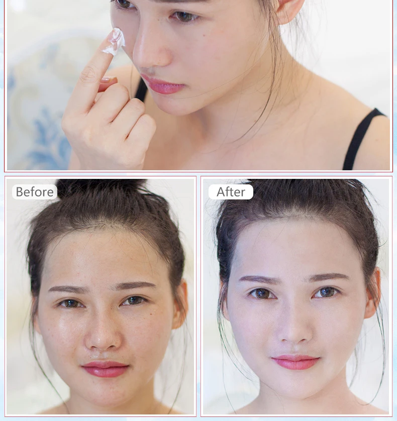 List 94+ Pictures Hydroquinone Cream Before And After Pictures Stunning