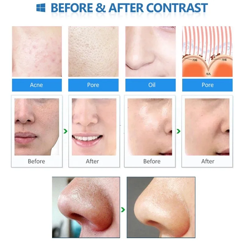 Microdermabrasion Machine Pore Tool Electric Facial Acne BlackHead Cleaner Remover Vacuum Dead Skin Diamond Peeling Machine