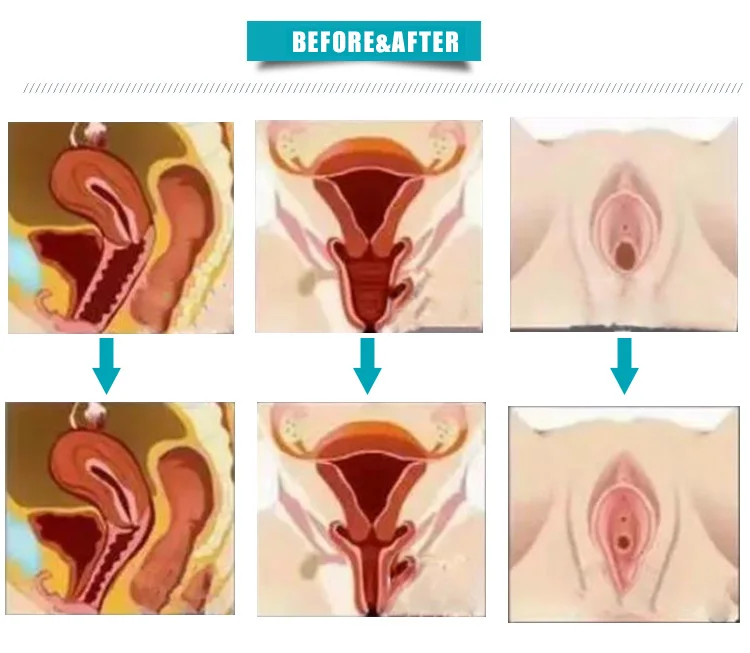 Woman private parts care vaginal tightening treatment equipment