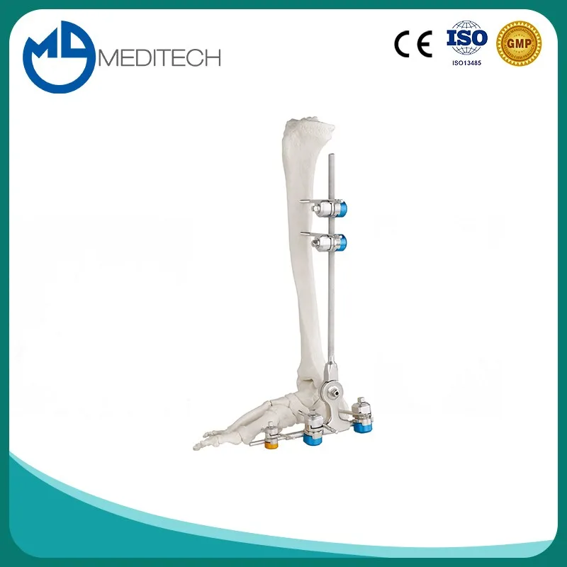 High Quality Orthopedic Ankle Joint External Fixation System Type Ii