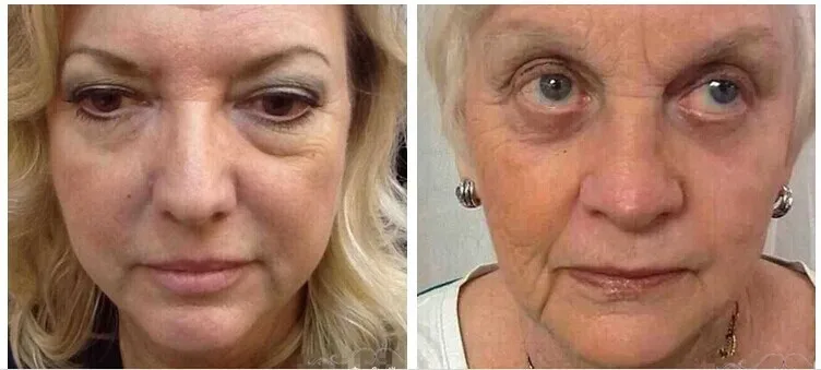 1x 2x 5x 10x 20x Boto x Instantly Ageless Argireline Face Lift Skin Care Product Powerful