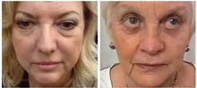 1x 2x 5x 10x 20x Boto x Instantly Ageless Argireline Face Lift Skin Care Product Powerful Anti-wrinkle Anti-aging