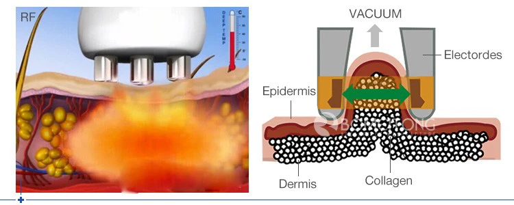 B0105 Portable Medical Ultra Cavitataion RF Vacuum Weight Loss Slimming Machine For Sale