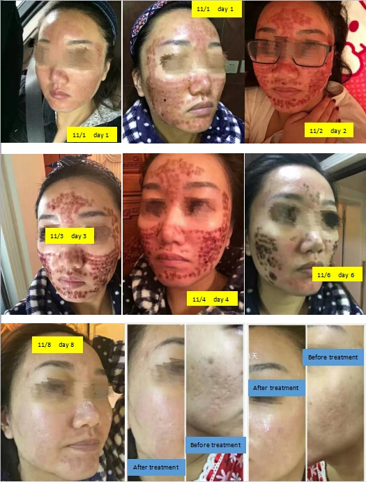 2019 Hot sale co2 fractional laser japan  for scar removal and vagina tightening