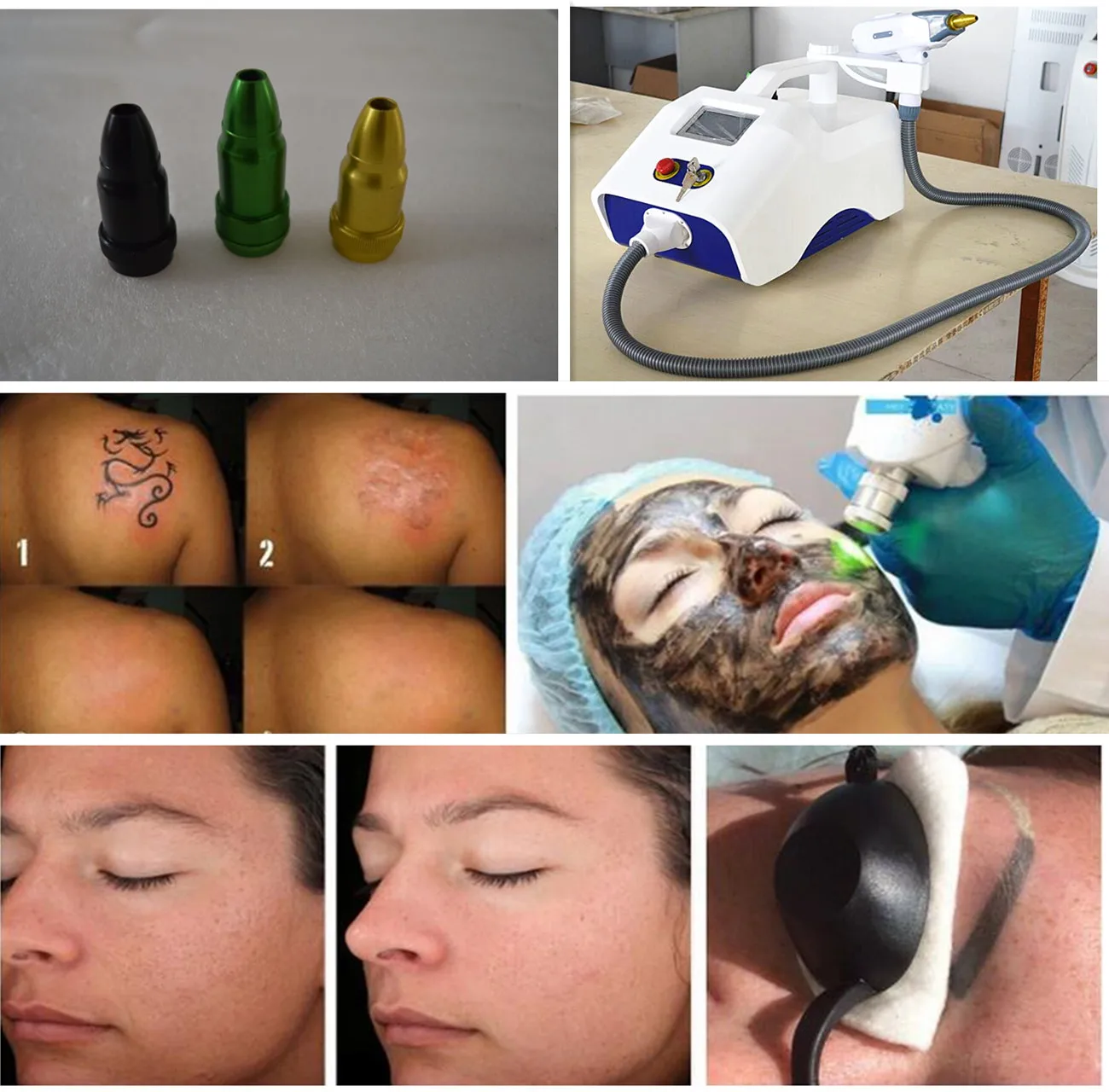 nd yag 激光洗纹身机