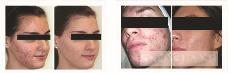 hydra dermabrasion.jpg