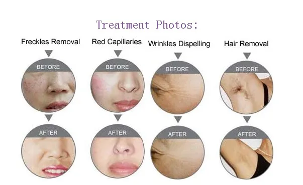 CE E-light IPL SHR Hair Removal Machine/ Elight SHR/ Shr Laser Ipl Skin Rejuvenation