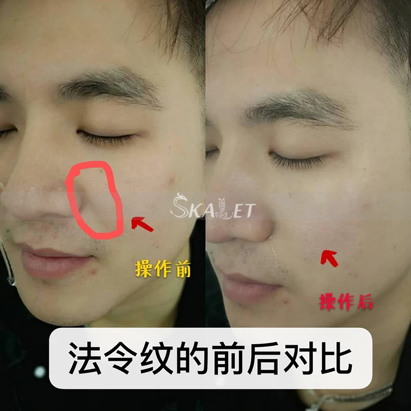 Professional Non-invasive Wrinkle Remover anti-bacterial with CE