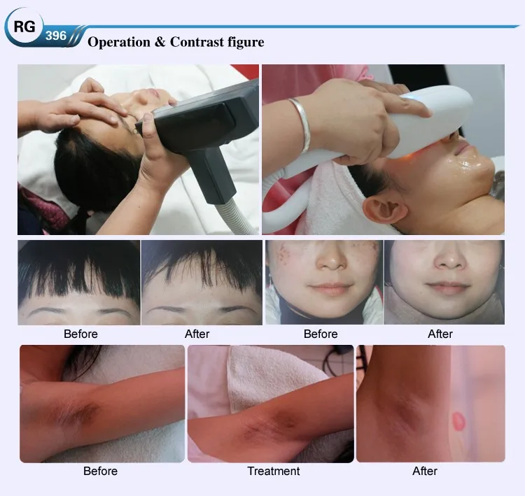 RG396 beauty machine treatment.jpg