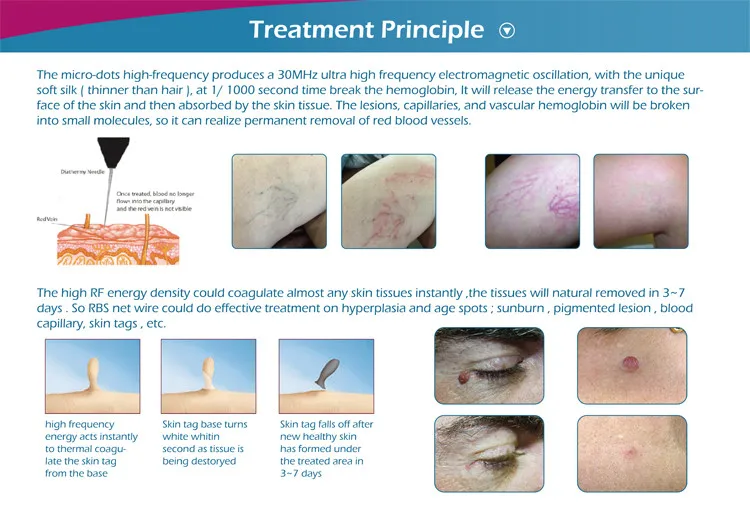 Most popular multi-color choice prevent varicose veins symptoms beauty device for customized style