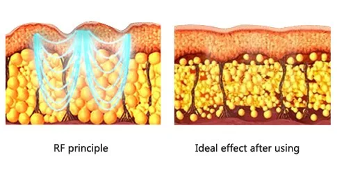 HONKON SIDEY Face Lift Skin Rejuvenation RF Wrinkles Removal Machine For Home Use