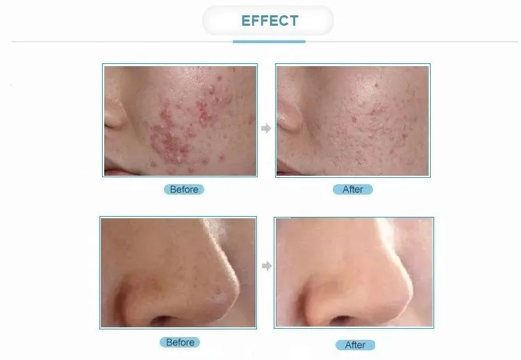 oxygen hyperbar facial machine