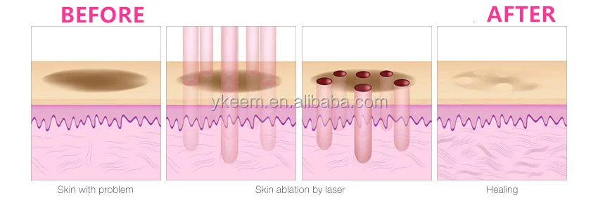fractional CO2 laser machine.png