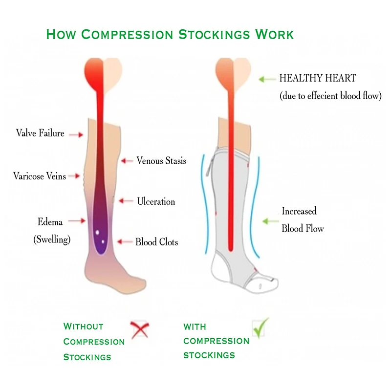 Compression Socks For Varicose Veins Factory Sale, 57% OFF   tercesa.com