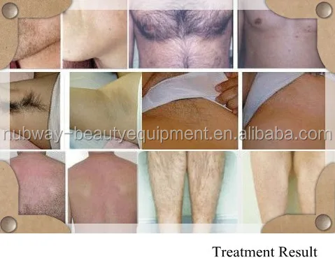 Hair-Removal-Diode-Laser-Machine Treatment Result.jpg