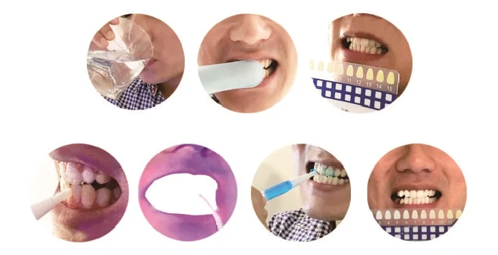 Can you use home teeth whitening kits when pregnant