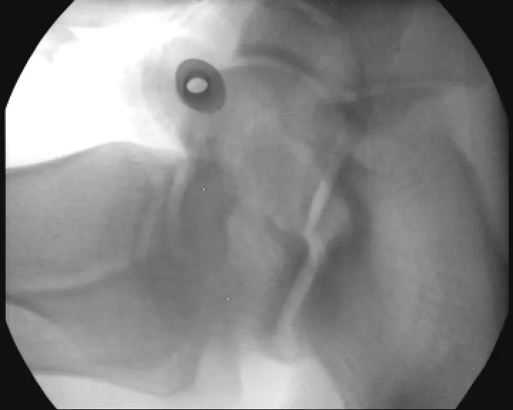LCD Low-Intensity Portable X-Ray Imaging Scope
