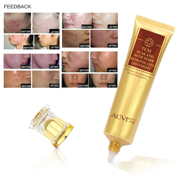 Anti Pimple Acne Scar Removal Face Treatment Cream Gel - Buy Acne And 