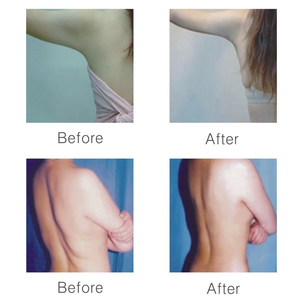 L carnitina inyectada antes y despues