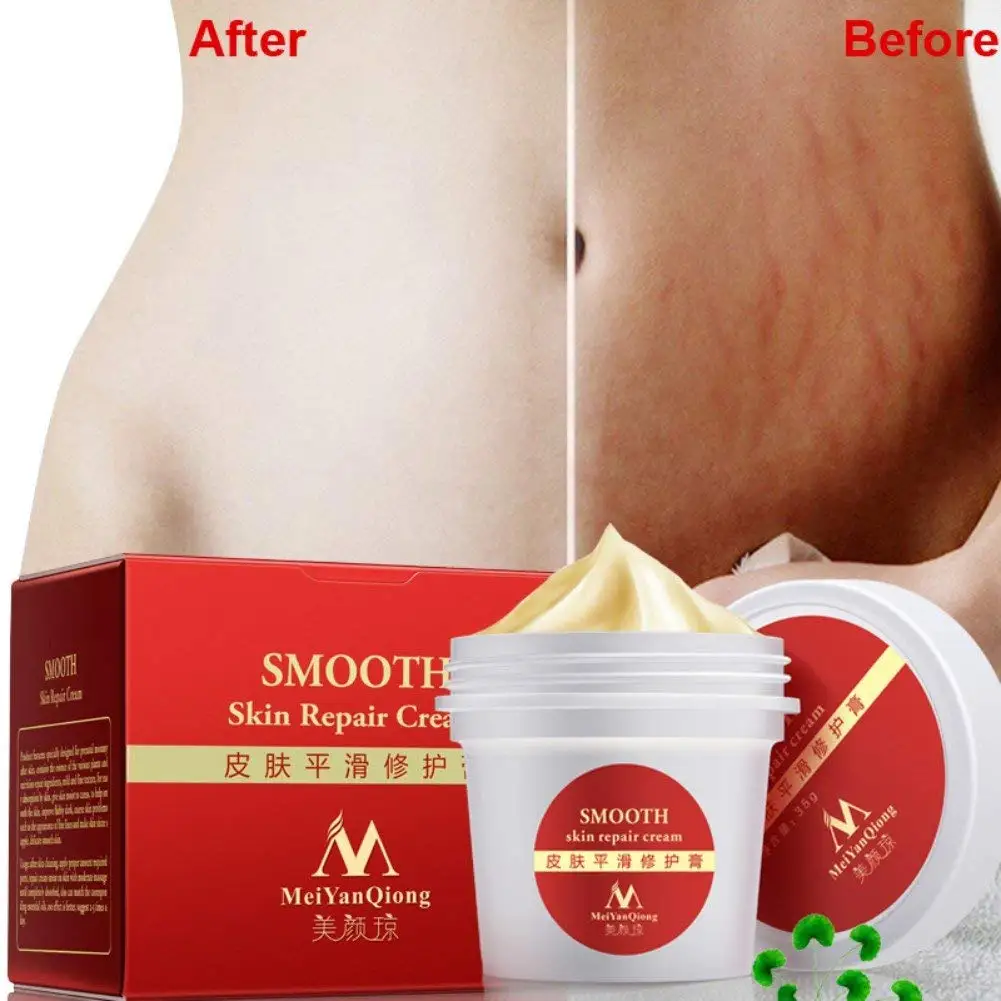 red stretch marks removal cream