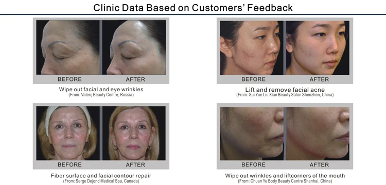 Piece electrical stimulation of facial muscles Due time electrical stimulation of facial muscles words... super