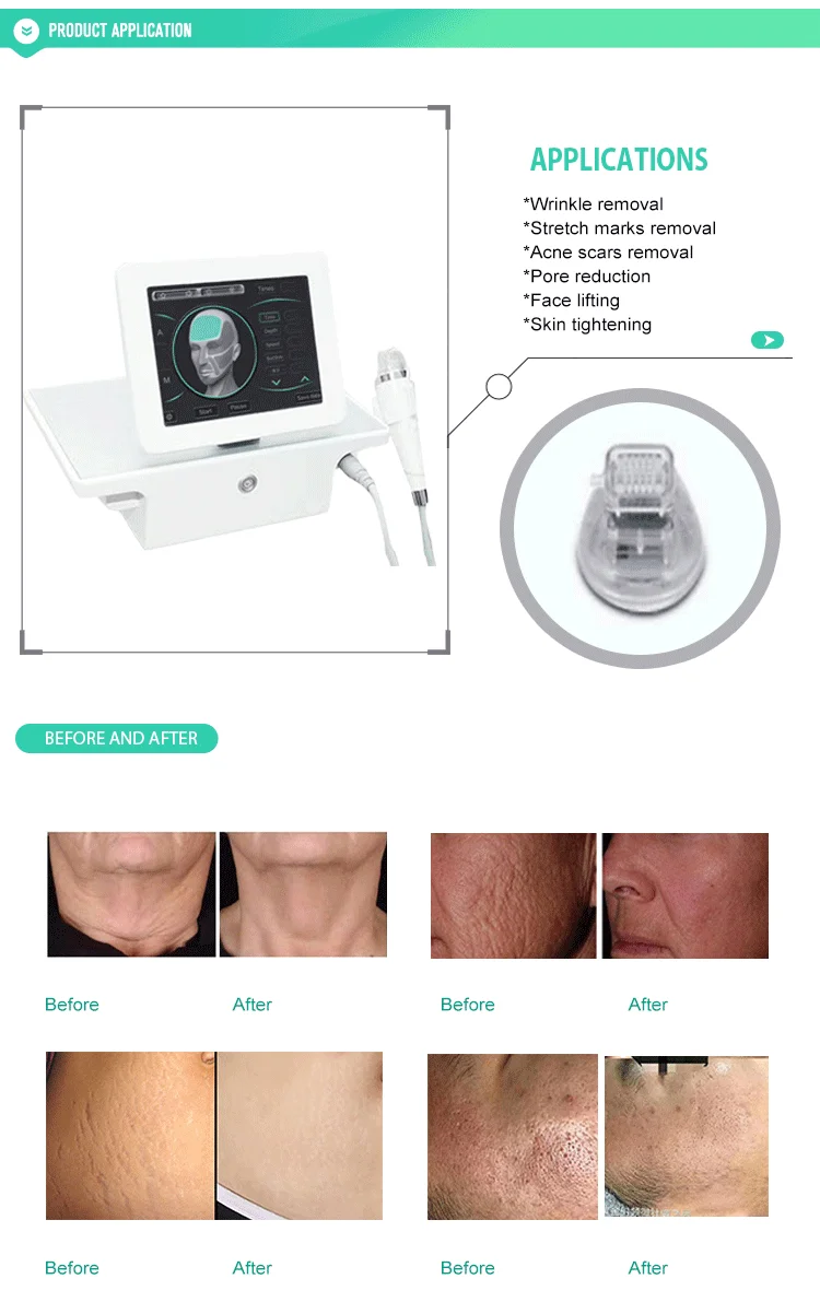 Stretch Marks Removal Features Professional Microneedle Fractional Rf