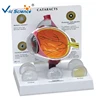 High Quality Medical Six Times Enlarged Human Plastic Cataract Eye Model For Sale