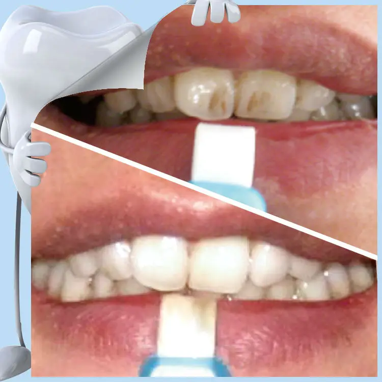 Cost For Teeth Whitening