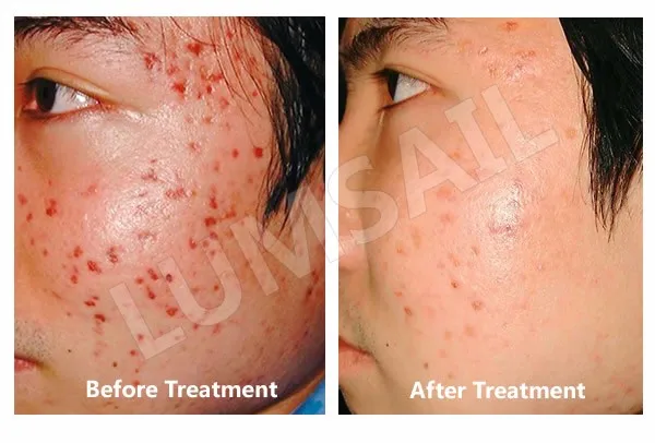 Acne treatment blue light
