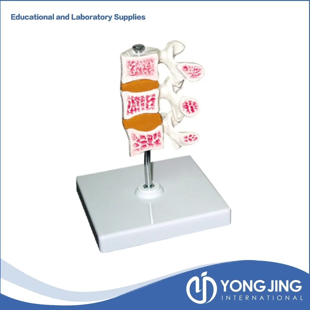 Mode of Osteoporosis,3 Bones.jpg