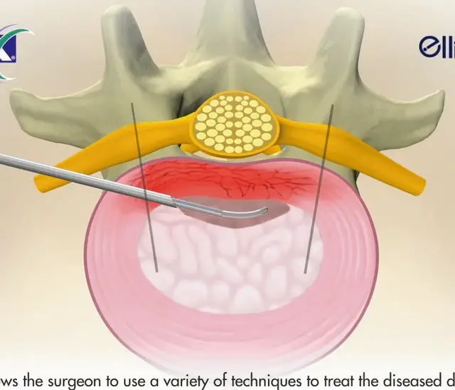 Bonss Microsurgery Spine Surgical System For Rf Bipolar Ablation Plasma