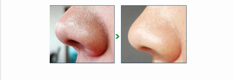 Korea Popular Vacuum Facial Pore Cleaner Blackhead Remover Suction  07.jpg