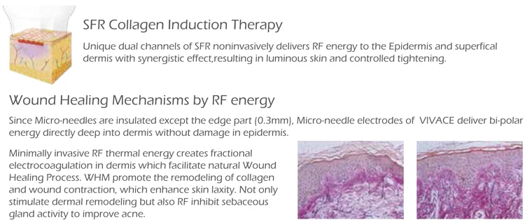 Best RF Skin Lifting Beauty Equipment Radio Frequency NonInvasive Invasive RF Anti-aging Wrinkle Removal