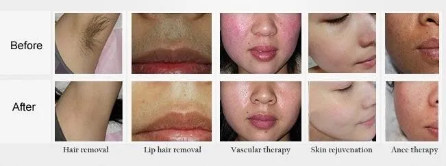 El retiro del pelo del OPT, opta m&aacute;quina de la belleza del elight, shr Alemania del IPL